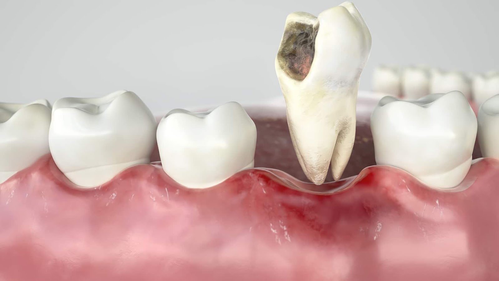 When Does Toothache Become a Dental Emergency?