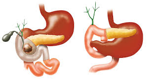 Understanding the Whipple Procedure: Step-by-Step Surgical Overview
