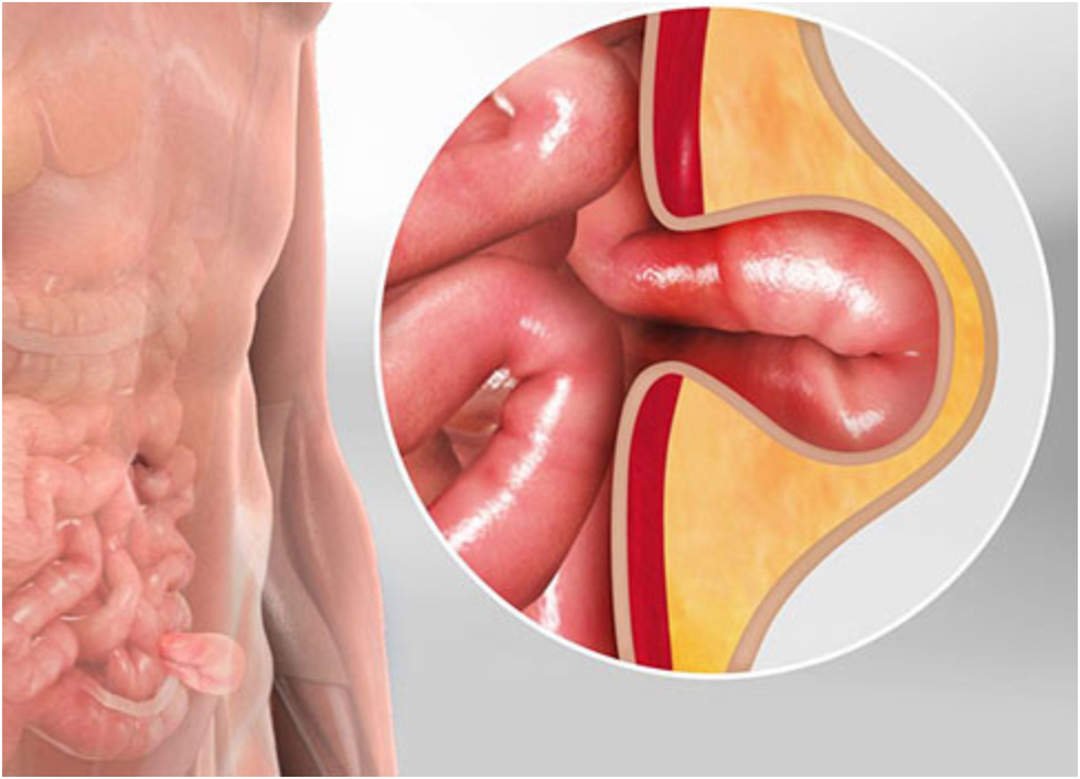 Open vs Laparoscopic Hernia Surgery: What Specialists Recommend