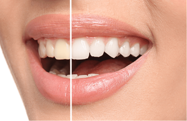 What Is the Procedure for Teeth Whitening?